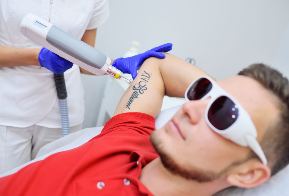 Tattoo Removal for Different Skin Types: Tips and Considerations Tattoo Removal treatment