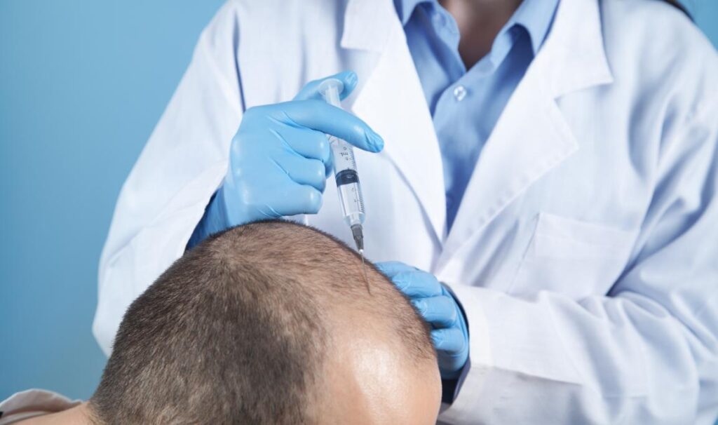 Battling Baldness: How Mesotherapy Can Combat Hair Loss 