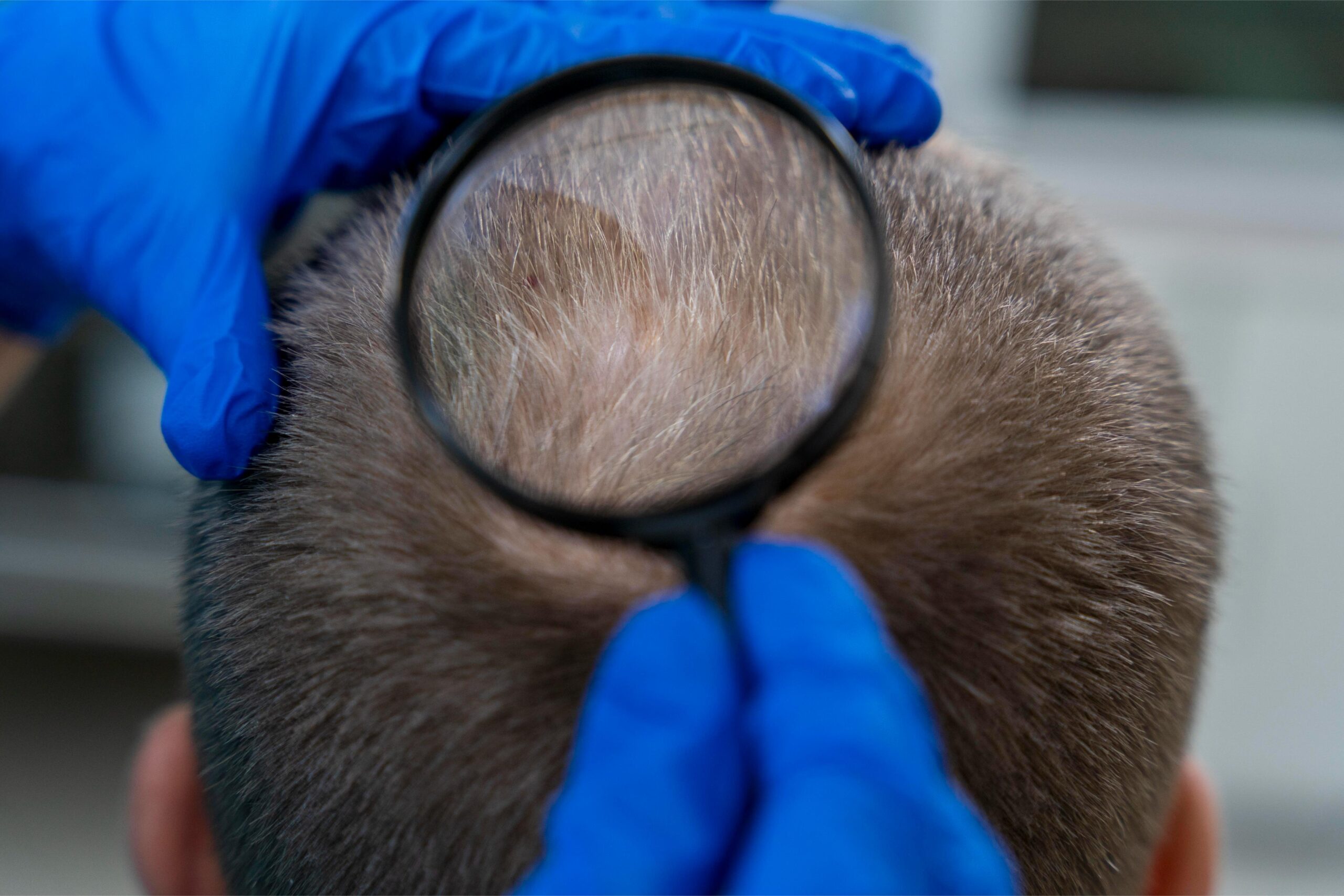 Harness Hair Fall Diagnosis and Treatment to Manage Your Hair Loss
