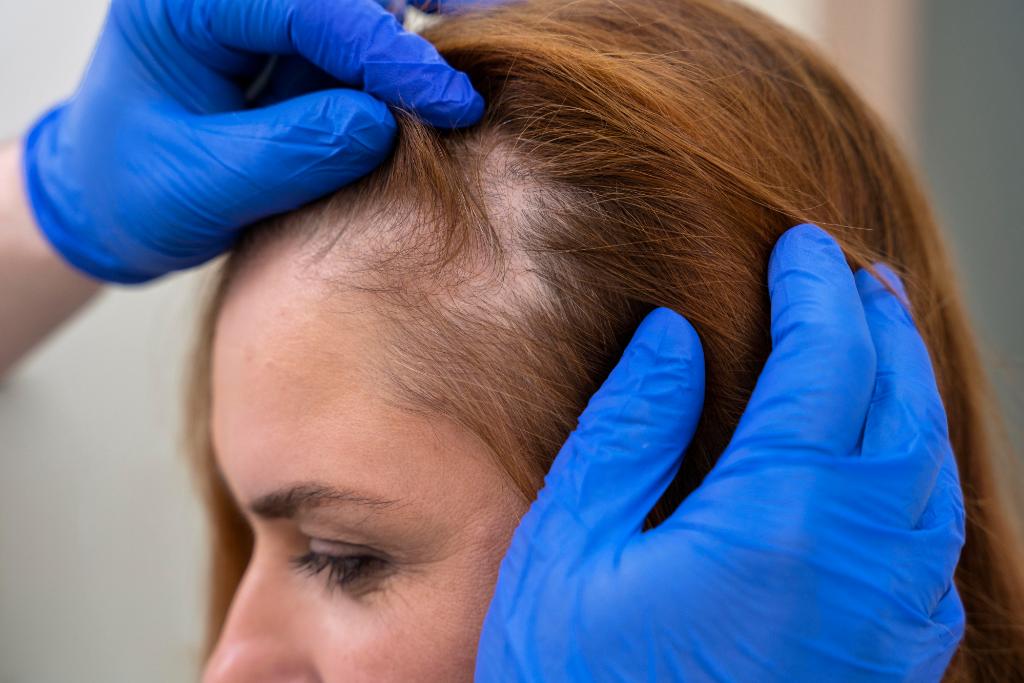 Sudden Hair Loss in Women: Causes, Remedies, and Prevention