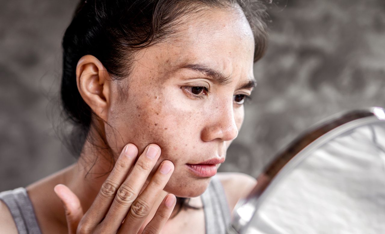 Dull Skin- Causes & Prevention