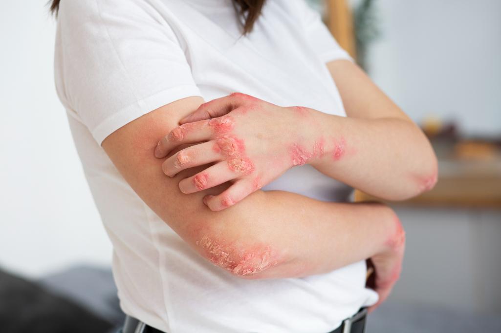 Skin Allergies: Causes, Symptoms, and Treatment