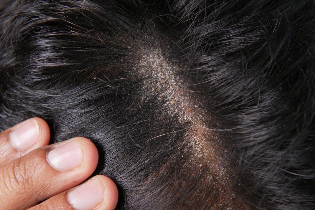 Scalp Micropigmentation For Scarring Alopecia Is a Game-Changer 