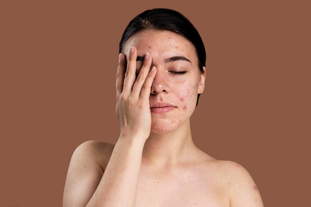 Exploring Acne: Types, Signs, Causes, and Cure