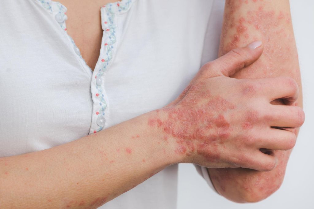 Skin Infections