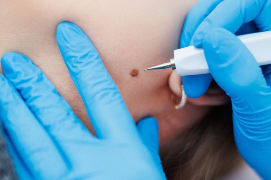 wart removal