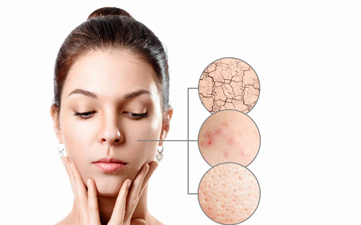 Acne affected facial skin with clogged pores and dryness