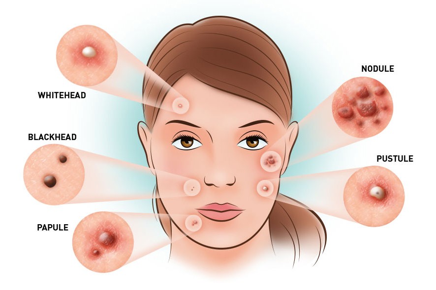 Different types of acne on face including whiteheads, blackheads, papules, pustules, and nodules